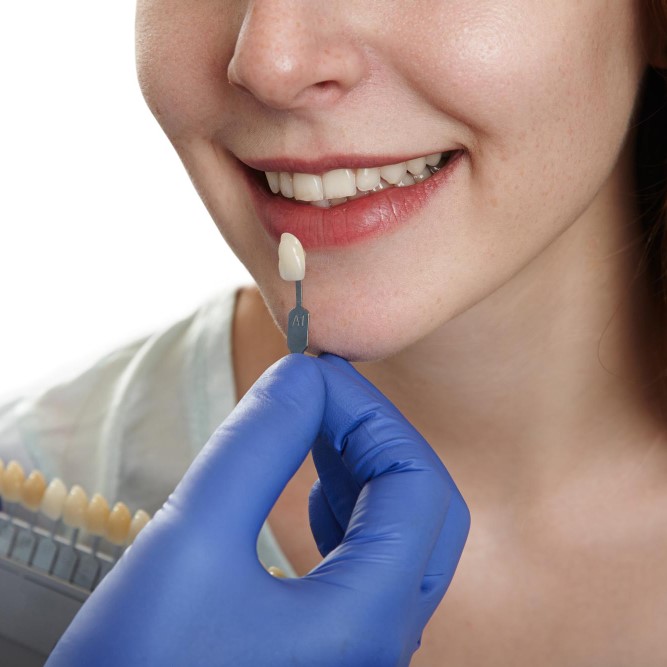 Dental Veneers & Laminates