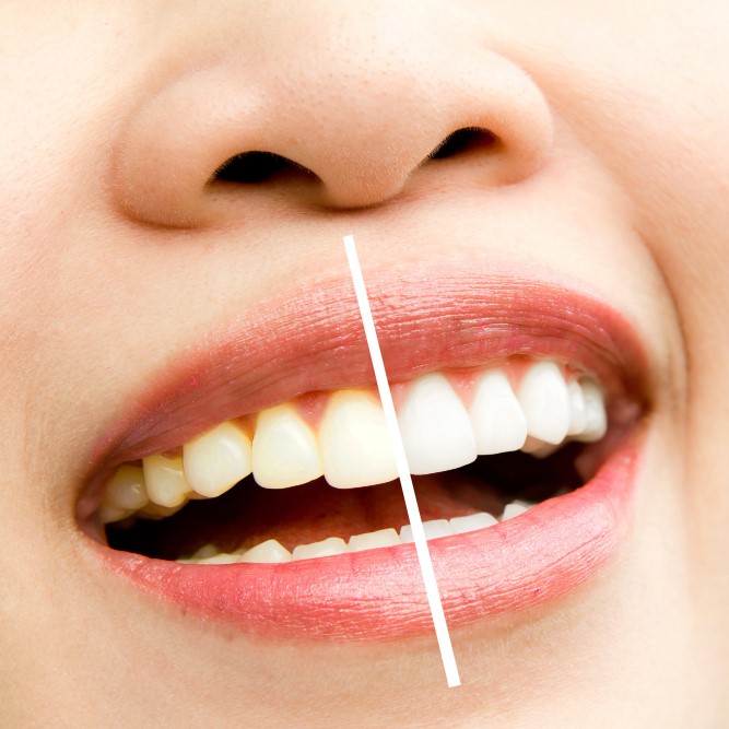 Tooth Whitening