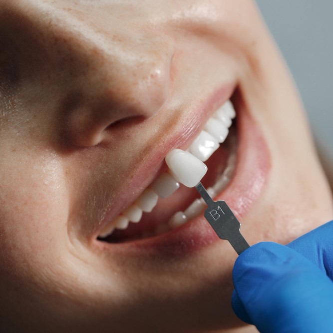 Dental Crowns & Bridges