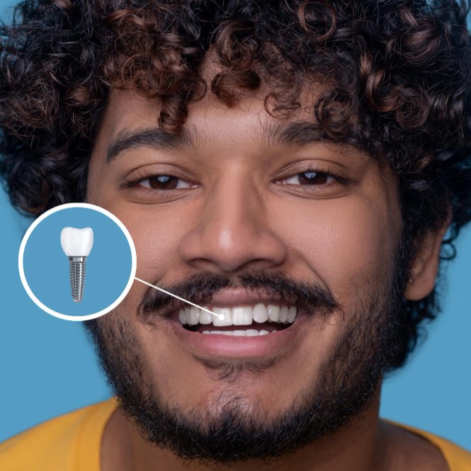 Dental Implants